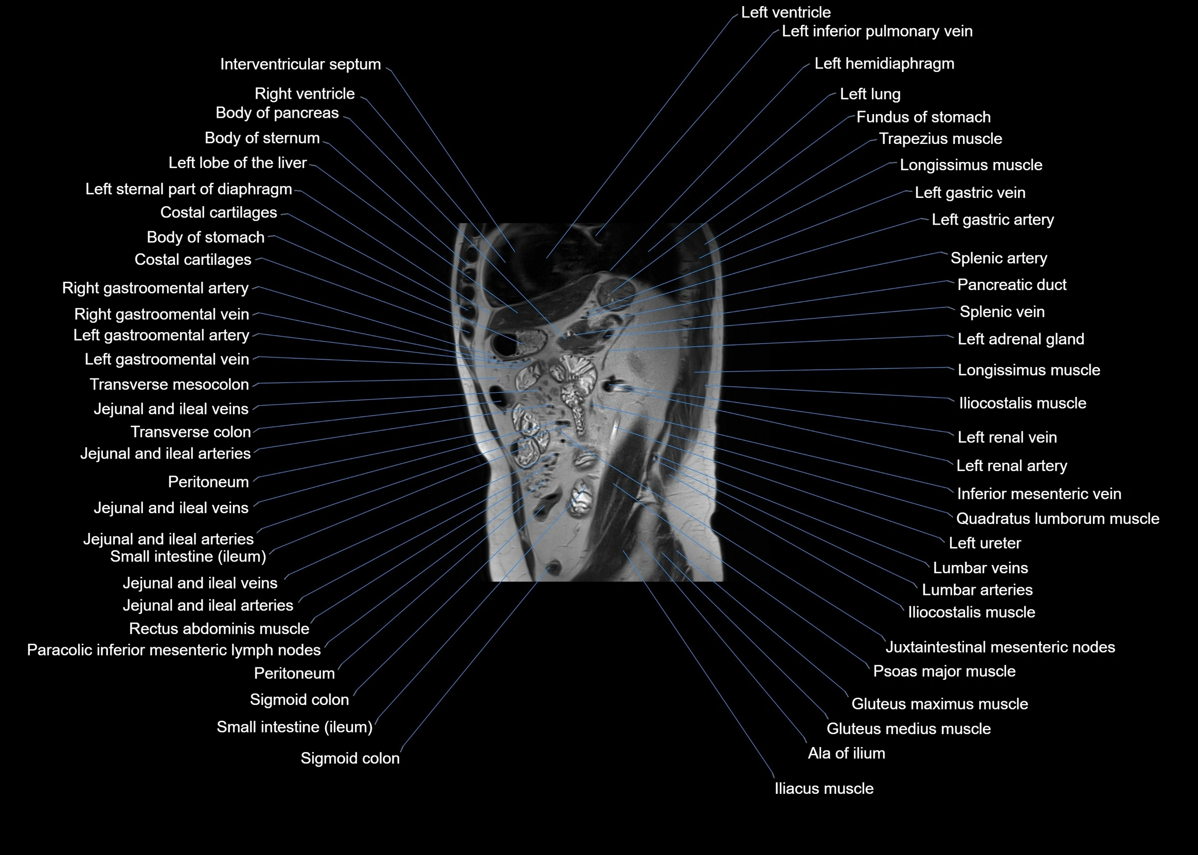 MRI abdomen sagittal cross sectional anatomy  radiology  image-img-00001-00045.webp